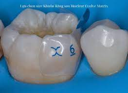 No.12 Bioclear Evolve Posterior Matrix 리필