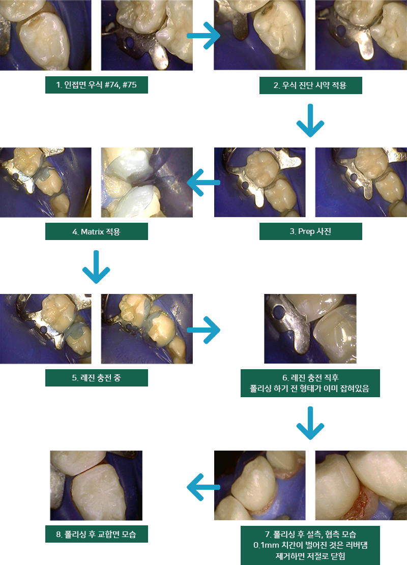 Bioclear Matrix 치료 과정 이미지